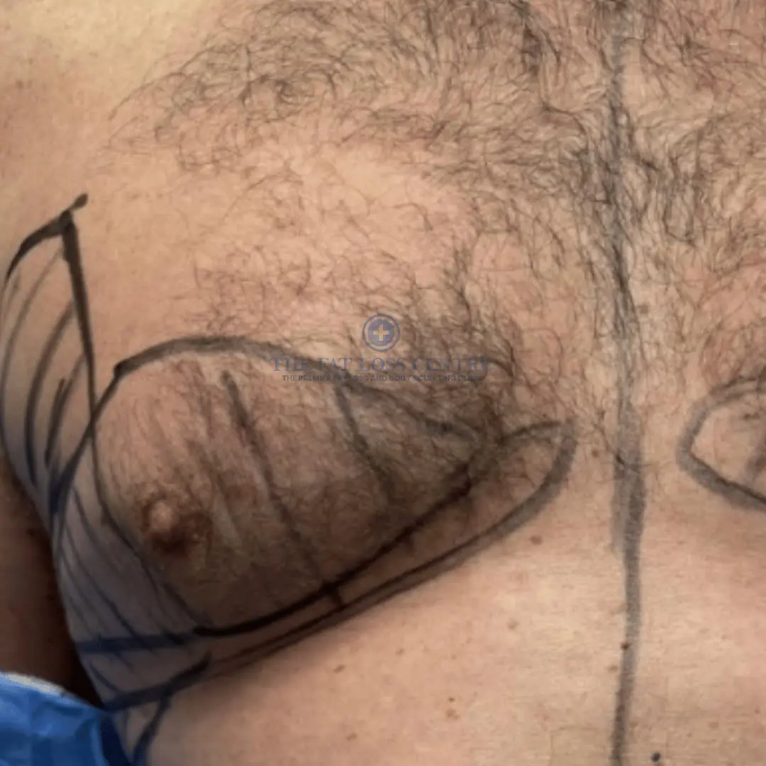 Male Chest before Male Chest VASER