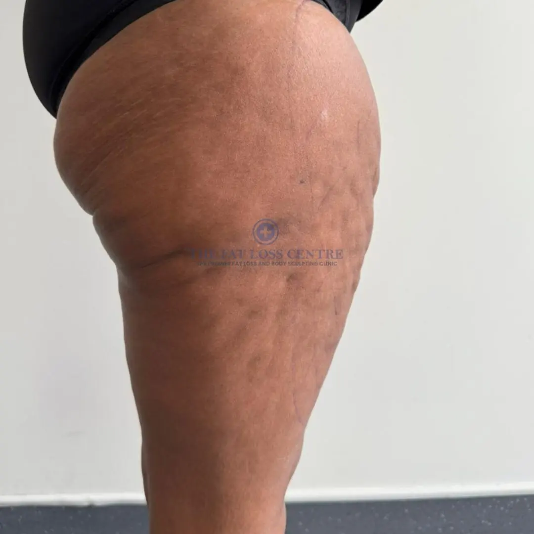 Upper Legs before VASER Lipo