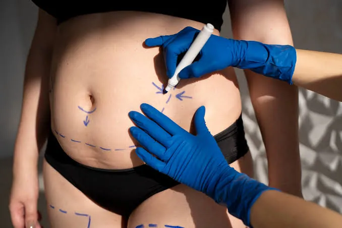 Clinician marking treatment areas on a patient's abdomen before VASER liposuction