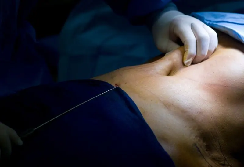 VASER liposuction cannula used during a body contouring procedure