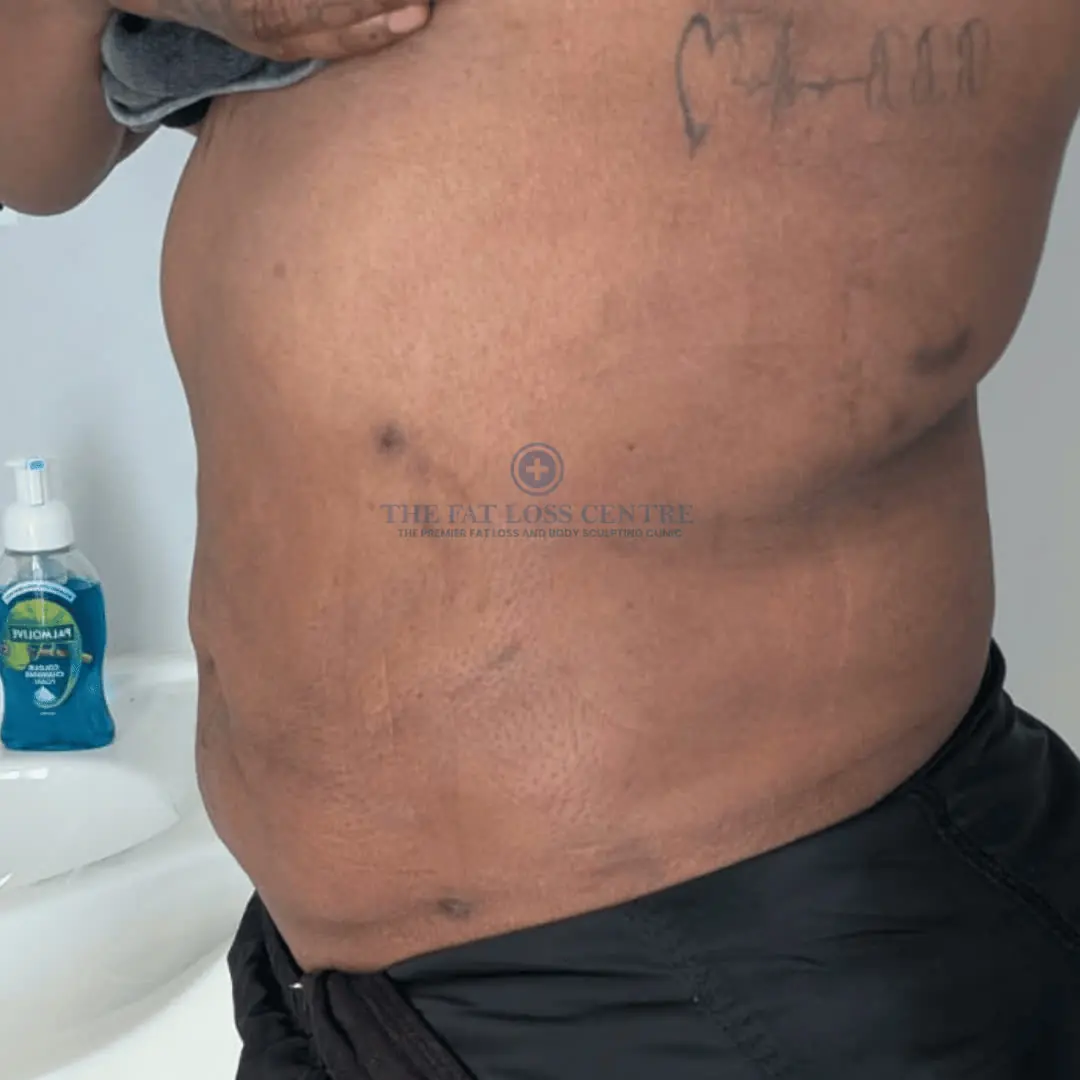Abdomen after VASER Lipo