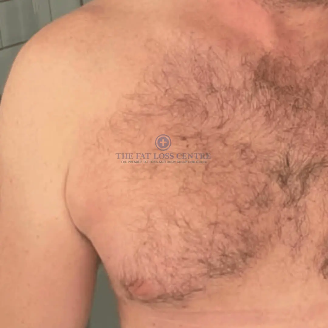 Male Chest after Male Chest VASER
