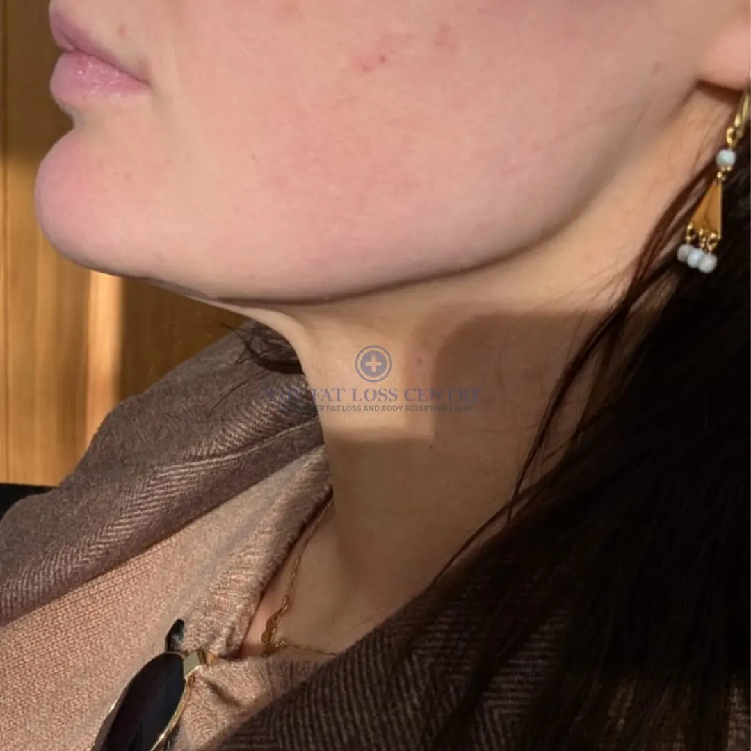 Neck after NeoLift