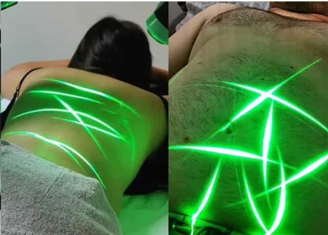 Green Laser recovery session being delivered to a patient's back and abdomen