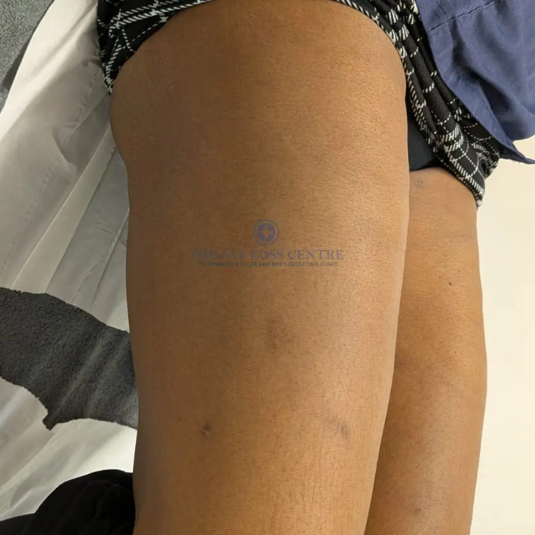 Upper Legs after VASER Lipo
